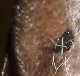 black spot on cat's ear